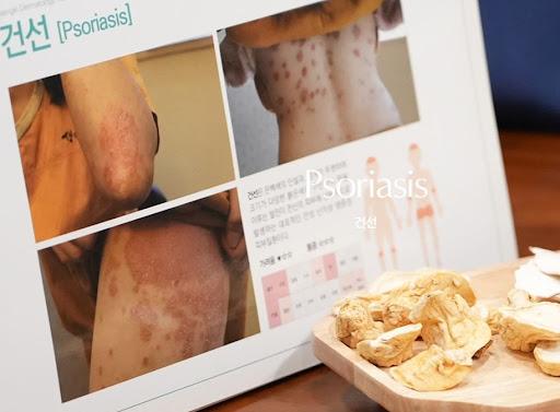 생기한의원이 설명하는 건선 생활관리 습관 점검 방법